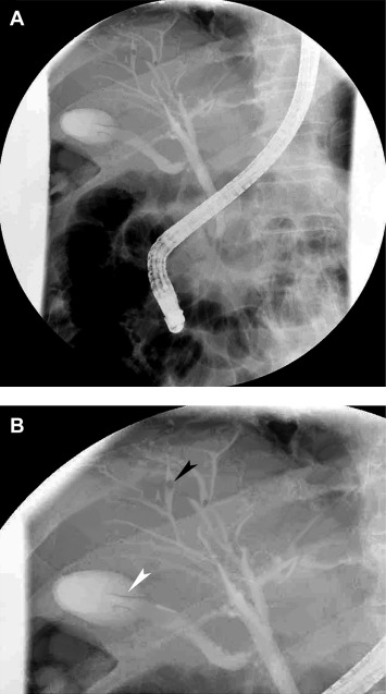 (A) Mild dilatation of peripheral intrahepatic ducts was noted. (B) Two ...