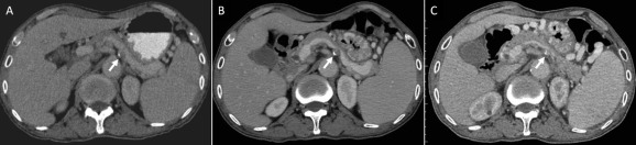 Serial contrast-enhanced abdominal computed tomography scans of the patient ...