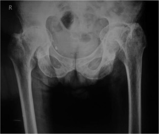 Pre-operative x-ray of a patient with protrusio acetabuli.