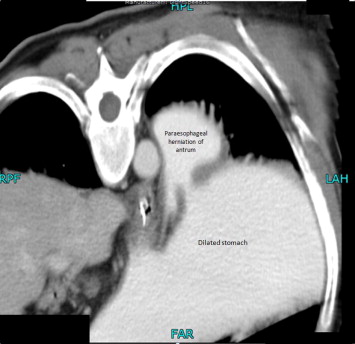 Computed tomography scan illustrating paraesophageal herniation of the antrum ...