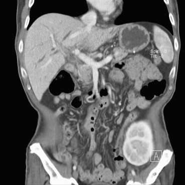 The normal distribution of the extra- and intrahepatic artery and the patency of ...