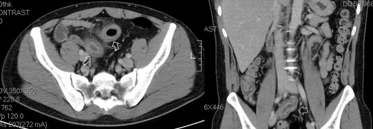An abdominal computed tomography shows edematous changes to the intestinal wall ...