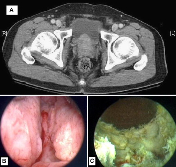 (A) Preoperative computed tomography showed advanced prostate cancer with ...