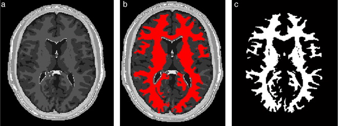 Materia blanca segmentada en volumen phantom de IRM del cerebro. (a) Corte axial ...