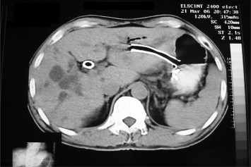 Follow-up computed tomography scan showed metallic stent drained at lesser ...