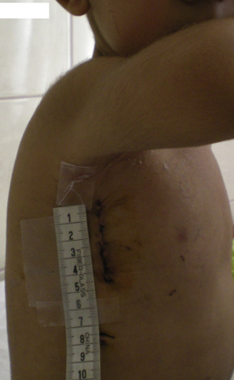 Skin incisions in the operations made with right vertical infra-axillar ...