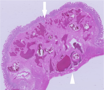 Histological examination shows that the tumor is composed of variably congested ...