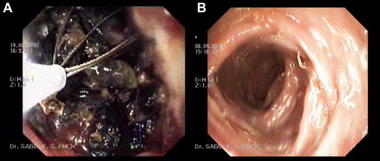 (A) Sigmoidoscopy showing gravel inside the rectum. Ulcerated mucosa and ...