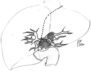 Illustration of hepaticojejunostomy revision.