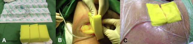 (A) Materials used for the dressing. (B) Placing the dressing on the infected ...