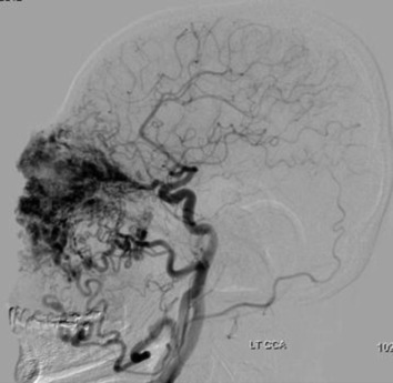 Left common carotid angiogram run shows extracranial arterial feeder of the AVM ...