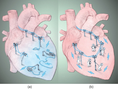 Reconnecting disrupted electrical signals in the infarcted heart. (a) Myocardial ...