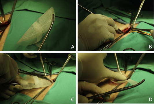 (A) Preparation of modified Kugel (MK) mesh before insertion. The mesh is folded ...