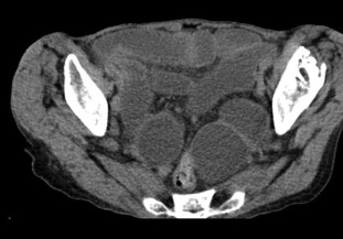 Dilated small bowel loops in the lower abdomen and pelvis.