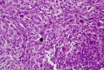 Hematoxylin and eosin staining of this liver tissue revealed some pleomorphic ...