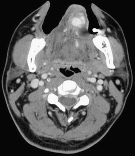 Enhanced computed tomography (CT) scanning shows an engorged, vascularized mass ...