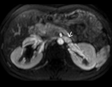 Magnetic resonance angiography showing a compressed left renal vein between the ...