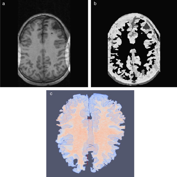 Segmentación 3D de la zona de la materia blanca en IRM del cerebro empleando ...