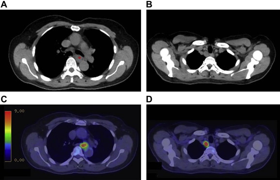 Preoperative radiological imaging demonstrating the patients esophageal ...