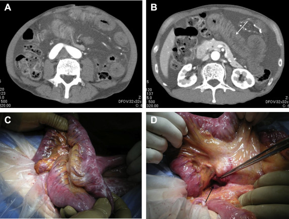 Abdominal enhanced computed tomography showed (A) significant ascites and (B, ...