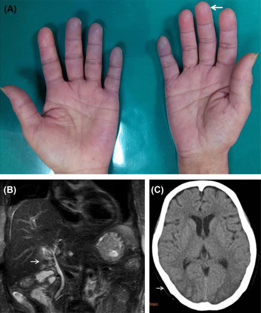 (A) The patient had Raynaud’s phenomenon and digital pitting scar (white arrow). ...