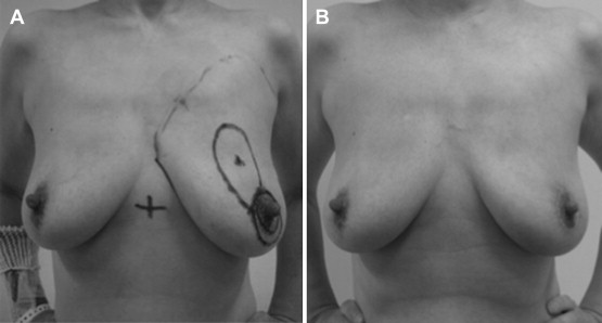 Case with excellent cosmetic results. The excision volume was 20% and the tumor ...