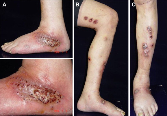 (A) One crusted verrucous plaque on the external aspect of the right ankle; (B ...