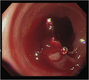 Endoscopic finding of active bleeding from a polypectomy wound. Two endoclips ...