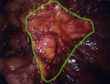 A right-sided adrenal tumor in a patient with an aldosterone-producing adenoma ...
