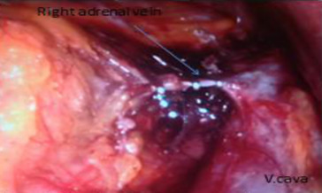 Clipping of the right adrenal vein.