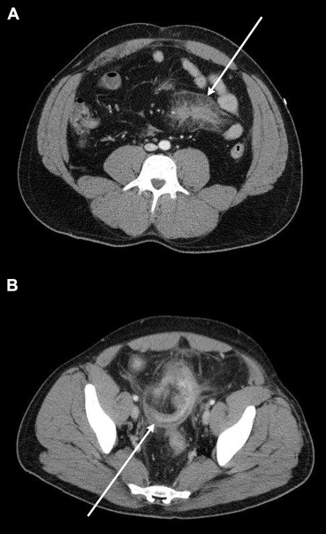 (A) Abdominal computed tomography immediately after trauma and (B) 5 weeks ...