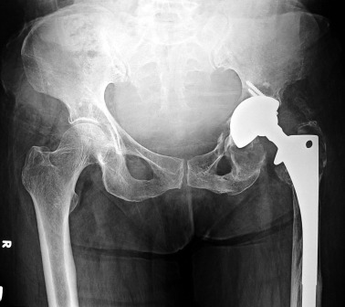 AP radiograph. Loosening and osteolysis around the acetabular component, loss of ...