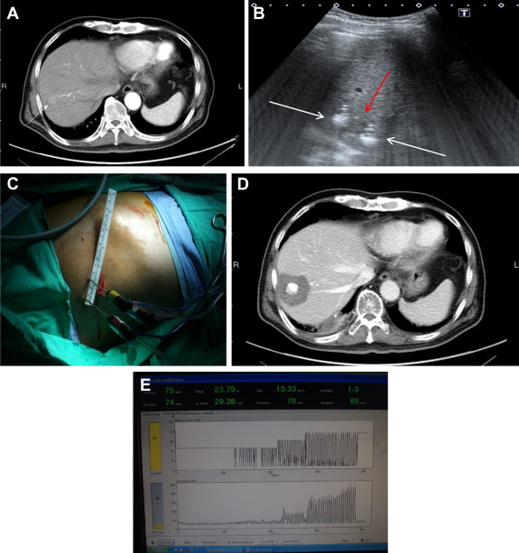 (A) One 2 cm HCC in the S7. (B) Three electrodes (white arrows) were deployed ...