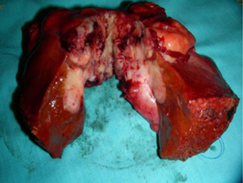 An 8 cm friable mass extending outward from the gallbladder and involving the ...