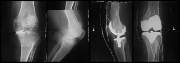 Preoperative and postoperative radiographs of the left knee.