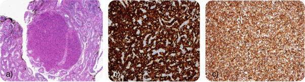 Histologia final – tumor de células de Leydig: unifocal; NITG ausente; sem ...