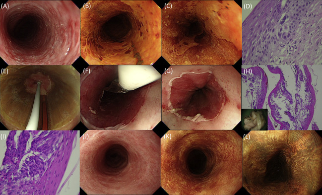 Endoscopic images prior to, during, and after balloon-based radiofrequency ...