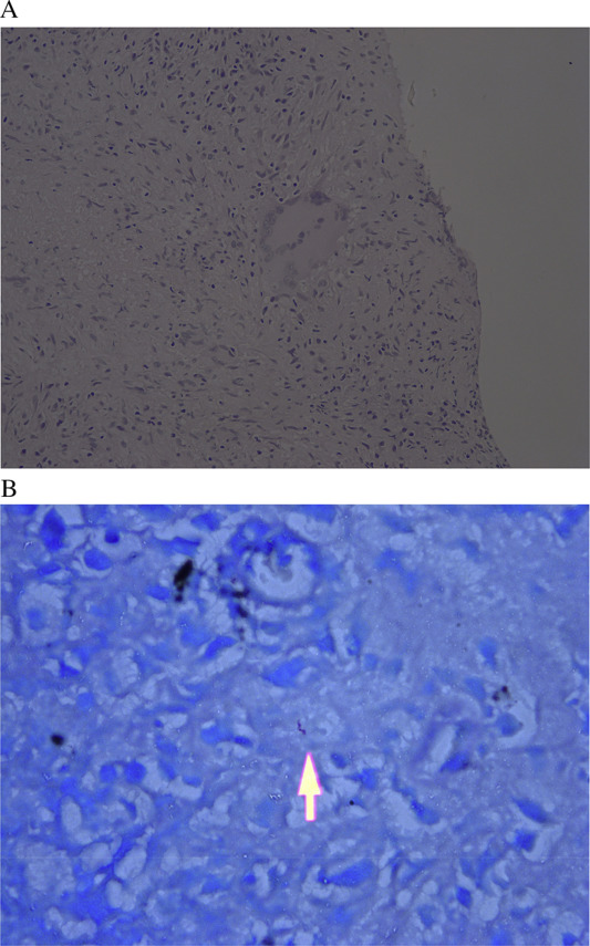 (A) Microscopically, granulomatous inflammation with caseous necrosis ...