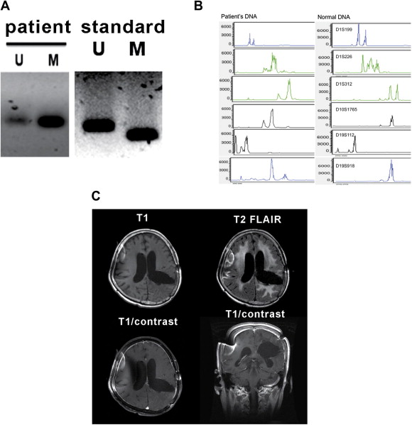 (A) Examinations for MGMT promoter of the tumor proved the tumor sample to be a ...
