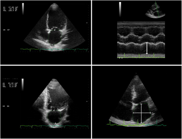 Left; left atrial volume measured using biplane (apical four, upper, and two ...