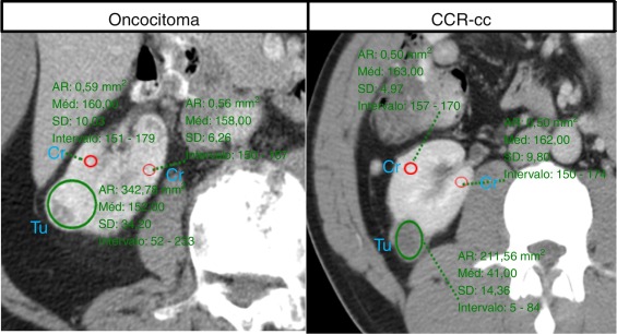 Determinação da atenuação de contraste em unidades de Hounsfield no tumor (Tu) e ...