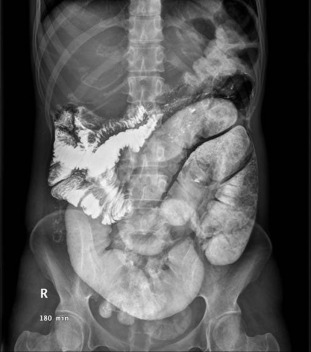 Barium meal study discloses marked dilatation of the segmental ileal bowel loops ...