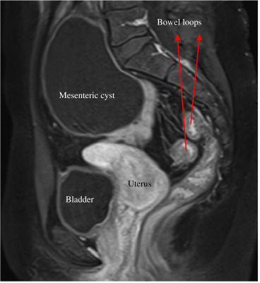 Sagittal view of the abdomen and pelvis on magnetic resonance imaging. The ...