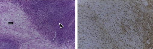 À esquerda tumor mostrando áreas celulares fusiformes‐padrão Antoni A (cabeça de ...
