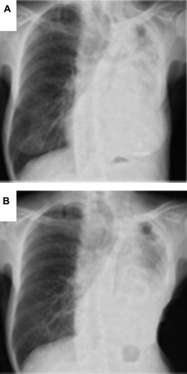 (A) Chest X-rays revealed a huge mass shadow in the left field and an ...