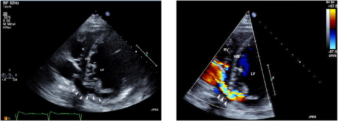 Transthoracic short-axis views without (A) and with color Doppler technique (B). ...