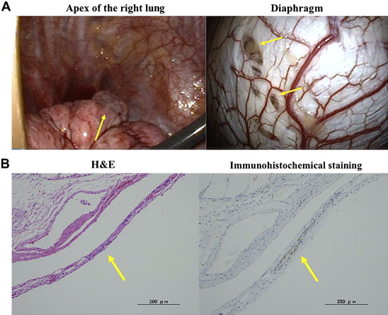 (A) Intraoperative findings of blueberry spot-like lesions in the tendinous part ...