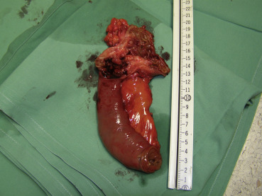 Segment of the duodenum 15.5 cm in length and 3.2 cm in diameter with exophytic ...