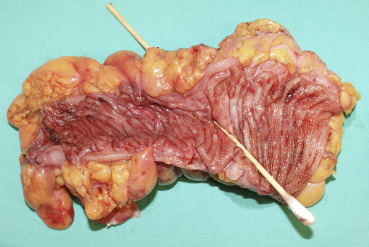 Gross examination of the specimen of segmental resection of the sigmoid colon ...