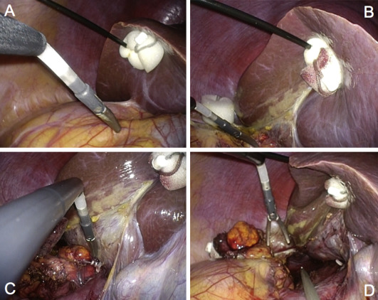 Needle-assisted laparoendoscopic single-site adrenalectomy (right side). (A, B) ...